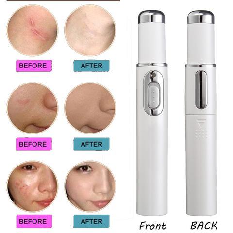 Blue Light Therapy Acne Laser Pen – Soft Scar & Wrinkle Remover